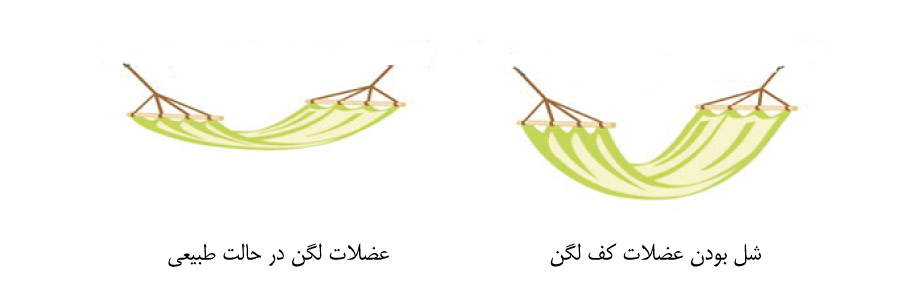 فیزیوتراپی کف لگن