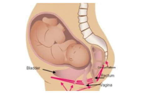 فیزیوتراپی کف لگن